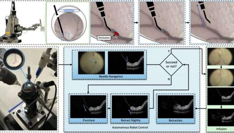 نظام روبوتي يمكنه أداء جراحة دقيقة جدا لعلاج انسداد الأوردة الشبكية