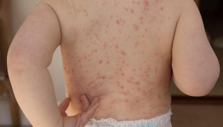 تفشٍ متسارع للحصبة بكارولاينا الجنوبية بأمريكا