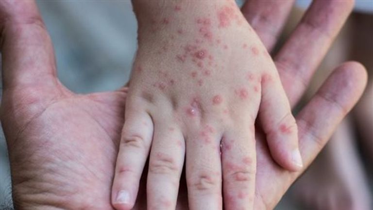 تفشٍ متسارع للحصبة بكارولاينا الجنوبية بأمريكا