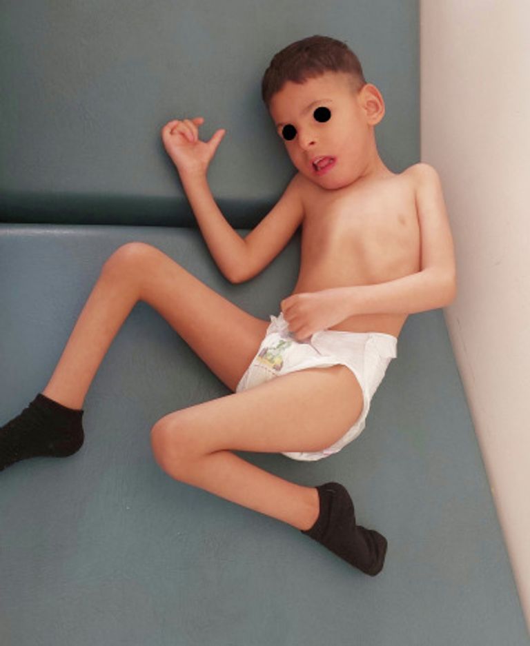  الاضطراب الوراثي المكتشف يؤدي إلى عجز الجسم عن إنتاج مادة أساسية لنمو الدماغ