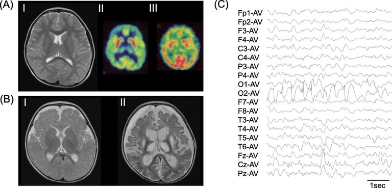  الاضطراب الوراثي المكتشف يؤدي إلى عجز الجسم عن إنتاج مادة أساسية لنمو الدماغ