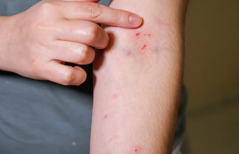 سرطان الجلد