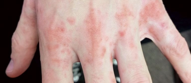 تحذير صحي عاجل من ارتفاع حاد في حالات الجرب ببريطانيا