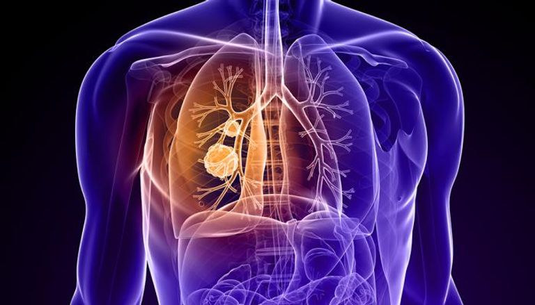 تحديد السبب وراء مقاومة بعض خلايا سرطان الرئة الشديد للعلاج