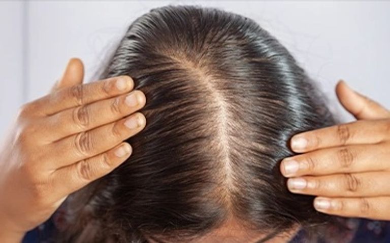 تساقط الشعر