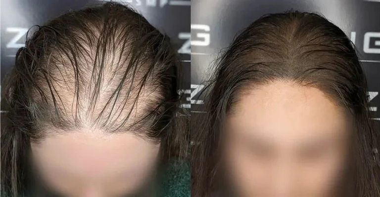 تساقط الشعر