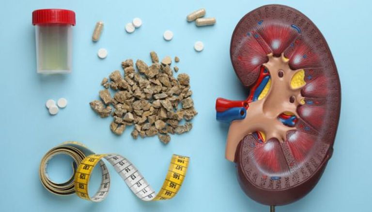 اكتشاف مسئولية  بكتيريا تشارك في تكوين حصوات الكلى