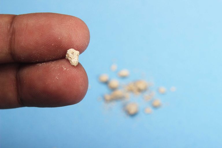 اكتشاف مسئولية بكتيريا تشارك في تكوين حصوات الكلى