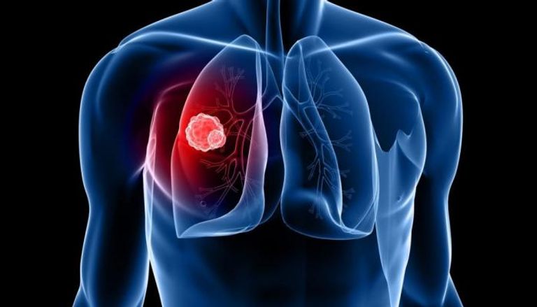 الذكاء الاصطناعي يسرّع تشخيص سرطان الرئة