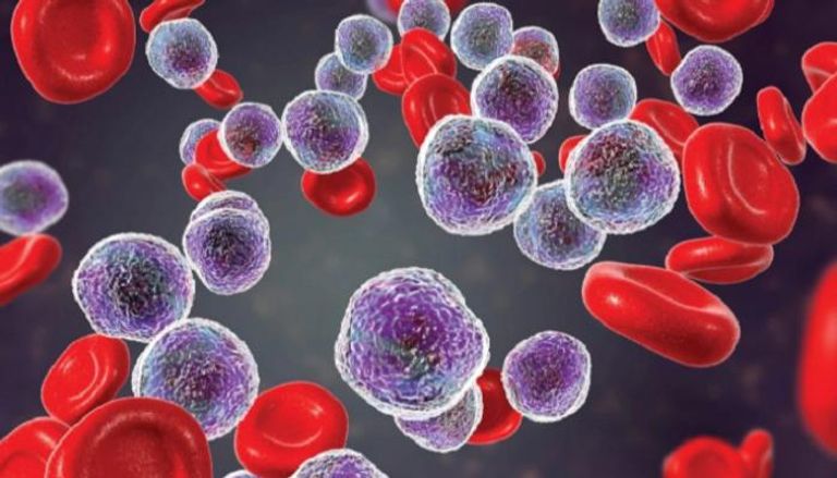 سرطانات الدم المزمنة تمثل تحديا علاجيا معقدا