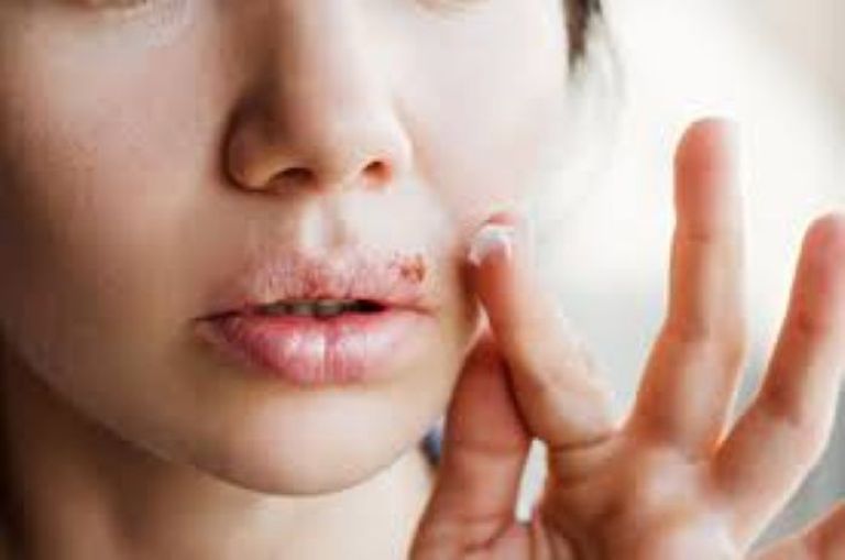 اختراق علمي غير مسبوق لتعطيل فيروس القُبَل - صورة 1