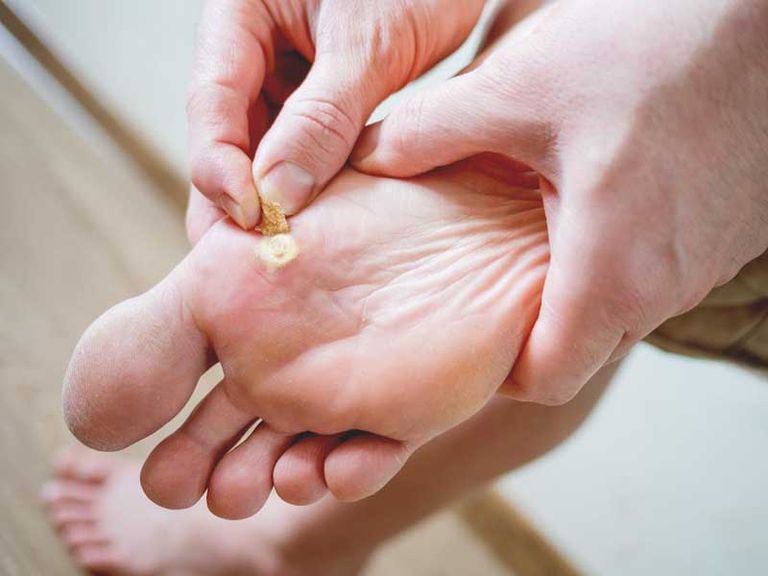 ثآليل اليدين والقدمين.. دليلك العملي للتعامل معها - صورة 1