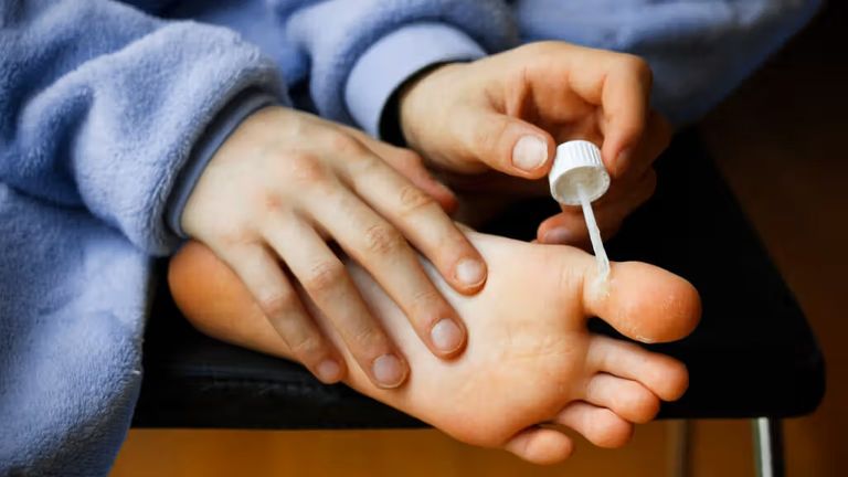 ثآليل اليدين والقدمين.. دليلك العملي للتعامل معها - صورة 2