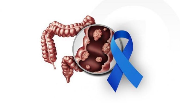 قلق يجتاح الأوساط الطبية.. انتشار سرطان القولون والمستقيم بين الشباب - صورة 1