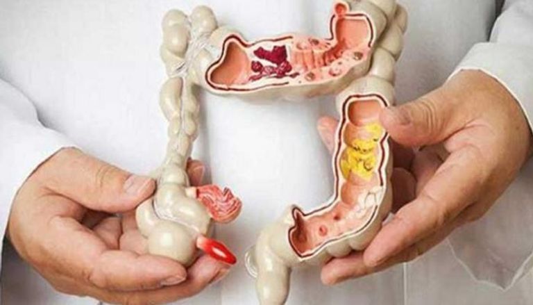 قلق يجتاح الأوساط الطبية.. انتشار سرطان القولون والمستقيم بين الشباب - صورة 2