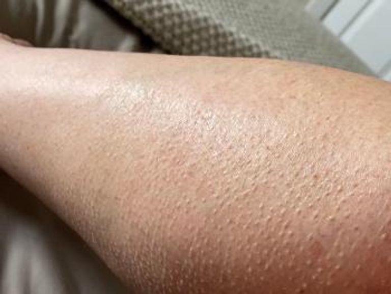 قشعريرة عشوائية بلا برد أو خوف.. هل تكشف مشكلة صحية خفية؟ - صورة 1
