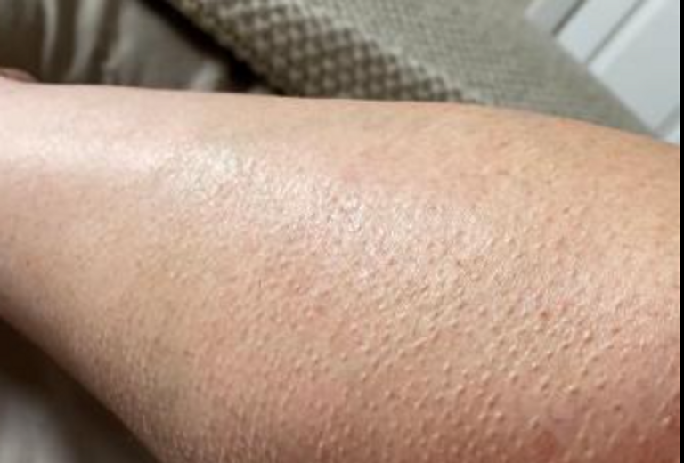 قشعريرة عشوائية بلا برد أو خوف.. هل تكشف مشكلة صحية خفية؟ - صورة 2