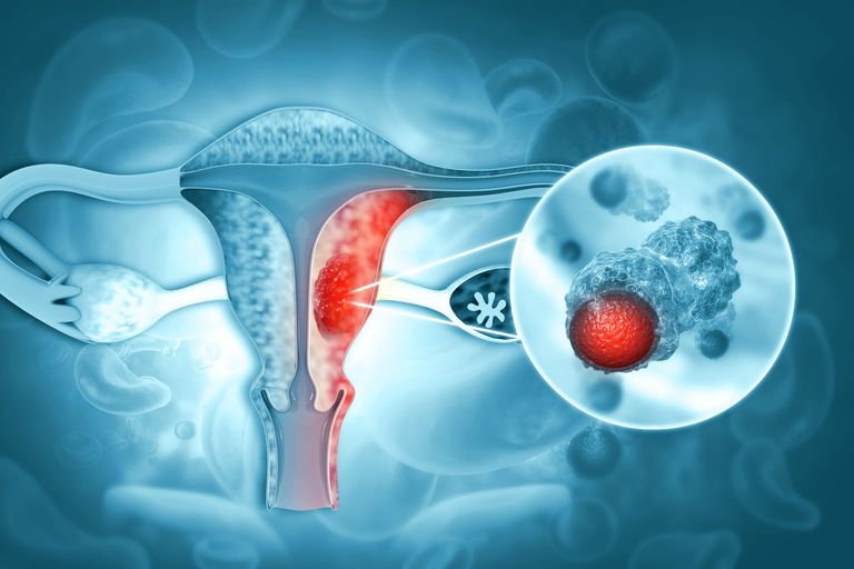 تشخيص مضلل.. باحثون يكشفون الخلط بين سرطان المبيض والاكتئاب - صورة 1