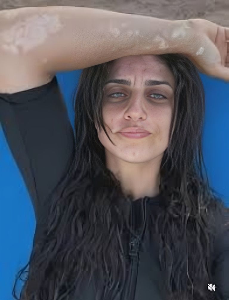 نجوم الفن يساندون شقيقة أمير كرارة بعد إعلان إصابتها بالبهاق - صورة 1