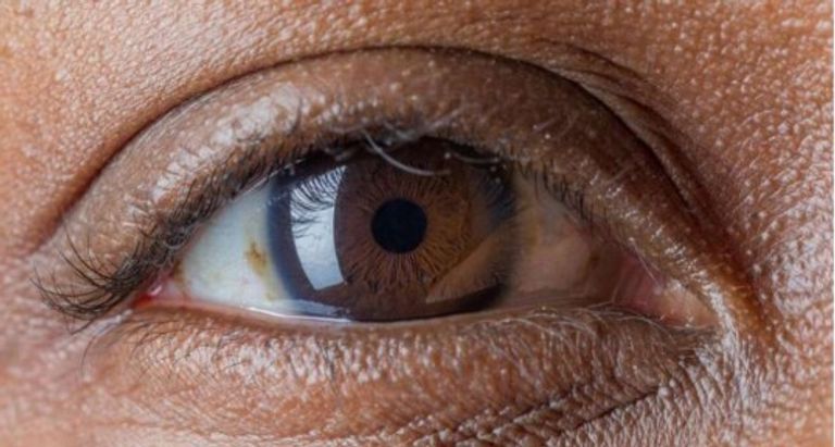 الجينات تكشف &laquo;السارق الصامت للبصر&raquo;.. دراسة تمهد للتنبؤ بالجلوكوما - صورة 1