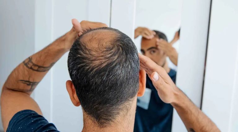 دراسة تفاجئ الرجال.. الصلع المبكر قد يقلل خطر الإصابة بسرطان البروستاتا - صورة 1