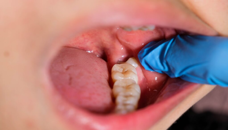 مراهقة تفقد 4 أضراس بسبب خطأ طبي في فرنسا خطأ طبي في فرنسا ينتهي بخلع 4 أضراس لمراهقة بدلا من جراحة الكاحل - صورة 1