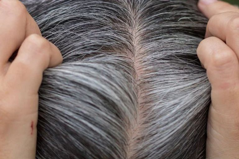 ليس العمر وحده السبب.. عادات يومية قد تسرّع ظهور الشعر الأبيض - صورة 2