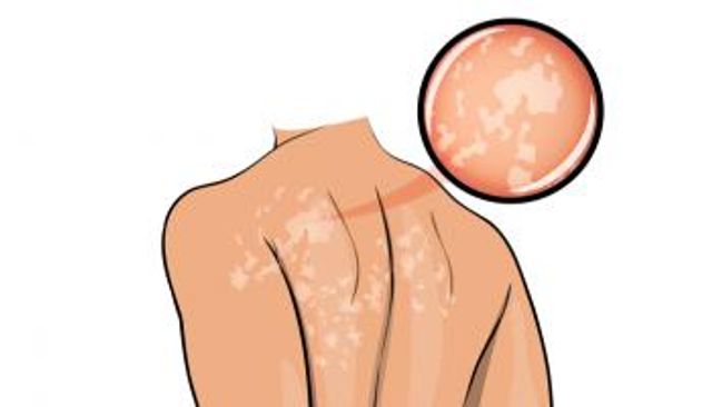 النخالية المبرقشة.. الأسباب والعلاج 