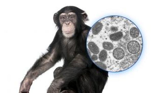 جدري القرود يتفشى عالميا