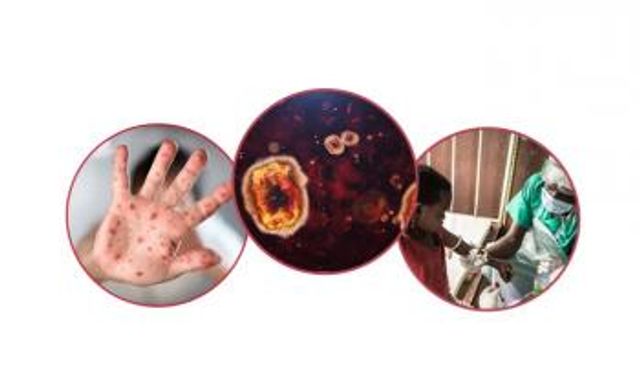 خطوات ضرورية عند ظهور أعراض جدري القرود