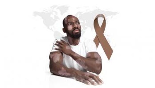 إنفوجراف.. اليوم العالمي للبهاق 2022