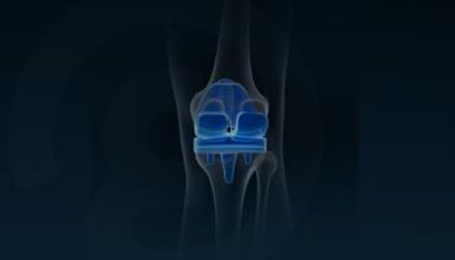 بعد تركيب مفصل صناعي.. المسموح والممنوع 