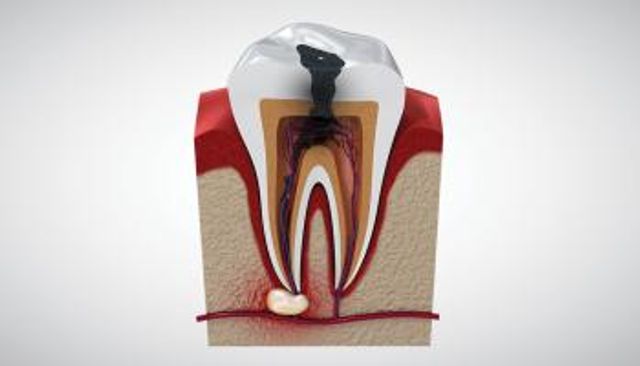 أسباب وعلاج التهاب جذور الأسنان