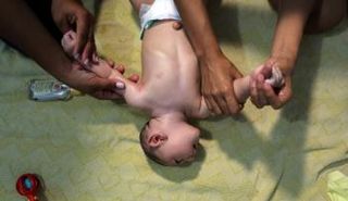 تأثيرات لفيروس زيكا على نمو المخ