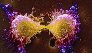 خلية سرطانية