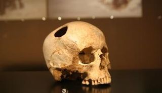 كسر الجمجمة قد ينقذ الكثيرين من الموت