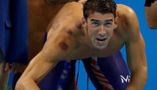 لاعبو الأولمبياد يظهرون بعلامات الحجامة على أجسادهم