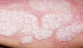 مريض بالصدفية