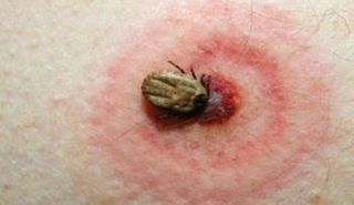 القراد المسبب لمرض لايم