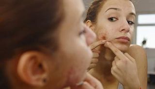 ظهور البثور وحب الشباب بعد البلوغ يؤرق الكثير من النساء والرجال