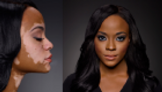 البهاق .. مرض