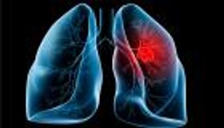 احترسوا .. سرطان الرئة ينتظركم في الخبز الأبيض ورقائق الذرة