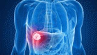 لجنة أوروبية تدعم عقارًا جديدًا لعلاج الالتهاب الكبدي