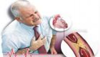 8 علامات لا تتجاهلها.. حتى لا تداهمك السكتة الدماغية