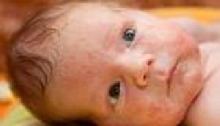 6 خطوات لمواجهة "حب الشباب" في وجه طفلك الرضيع