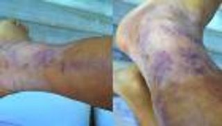 صورة صادمة لساق سانشيز تفضح وحشية مدافعي الأرجنتين