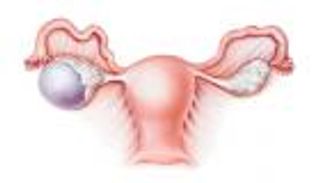دراسة: الفحص الدوري يحدّ من وفيات سرطان المبيض