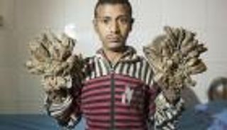 بالصور.. شاب تنمو جذور الشجر في يديه