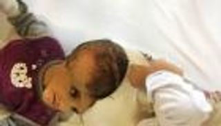 22 طبيبًا سعوديًّا يفصلون توأمًا ملتصق الرأس