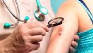 عقار بريطاني جديد لعلاج سرطان الجلد "الميلانوما"